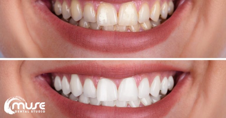 Blog banner: Smile Makeover