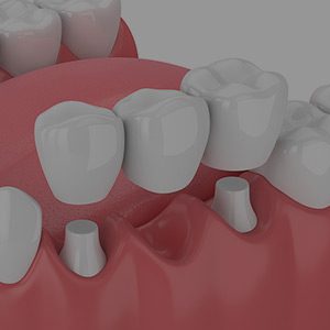 Dental model showing bridges and crowns