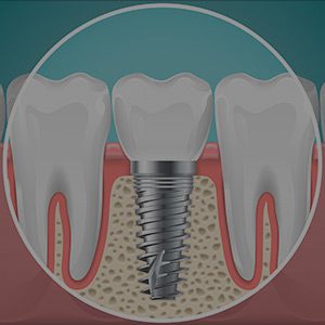 Image of dental implants model